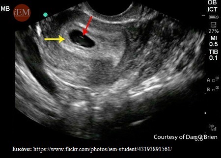 iperixografima3