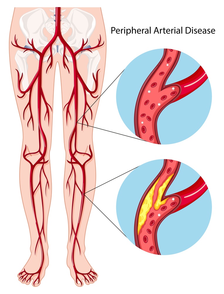 Peripheral-arterial-disease