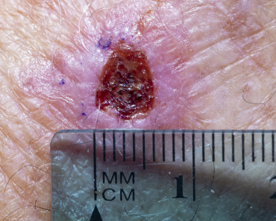 Skin-Cancer