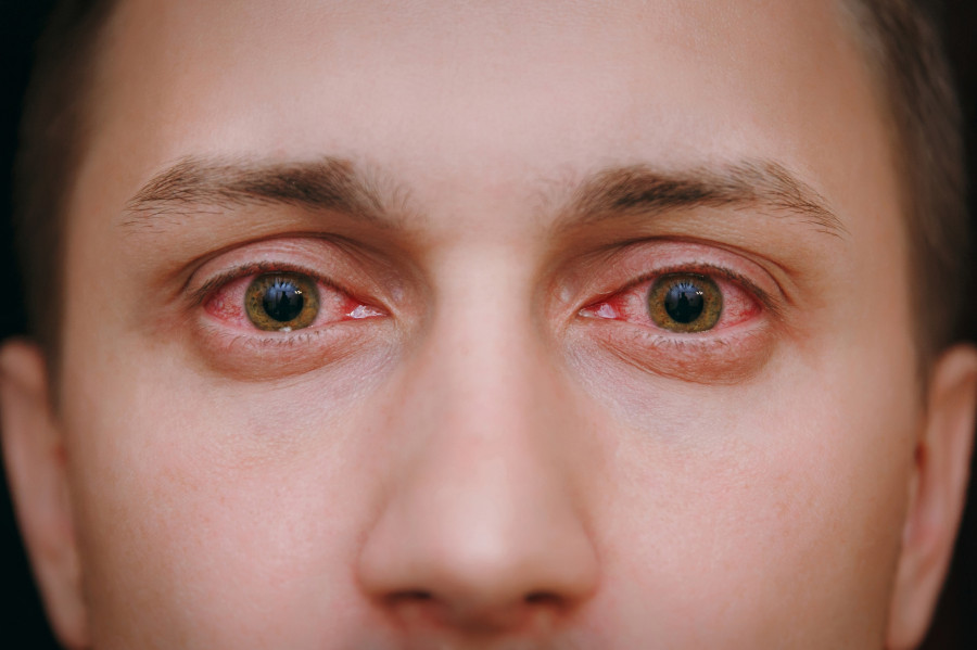 Red-Blood-Eyes-Conjunctivitis