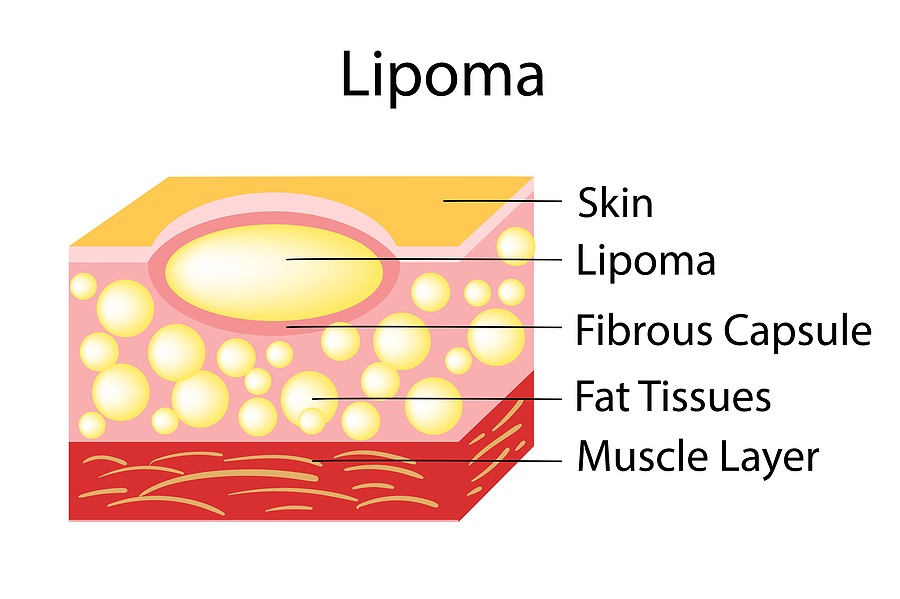 Lipoma