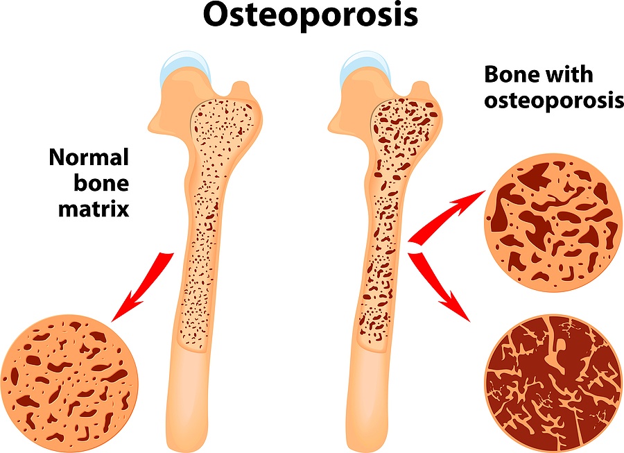 Osteoporosis