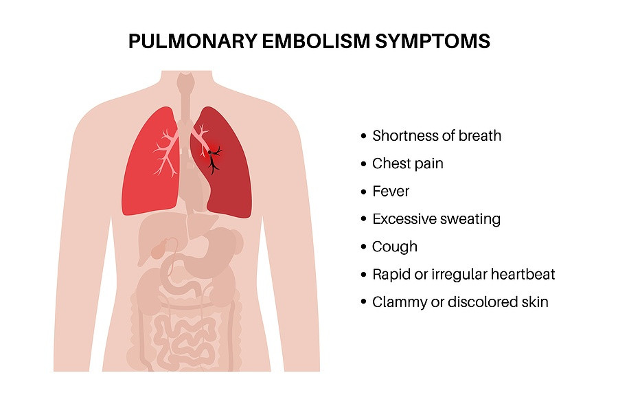 Pulmonary-Embolism