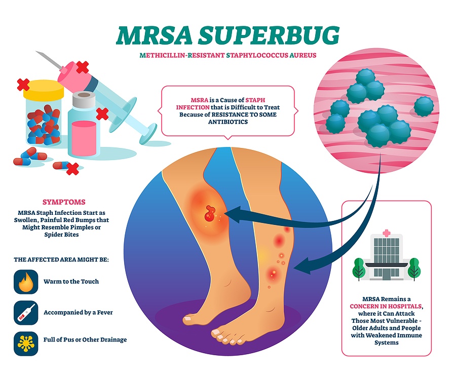 MRSA-Staph-Infection